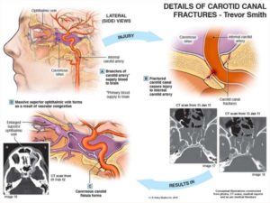 Using Technology To Illustrate Complex Car Accident Injuries